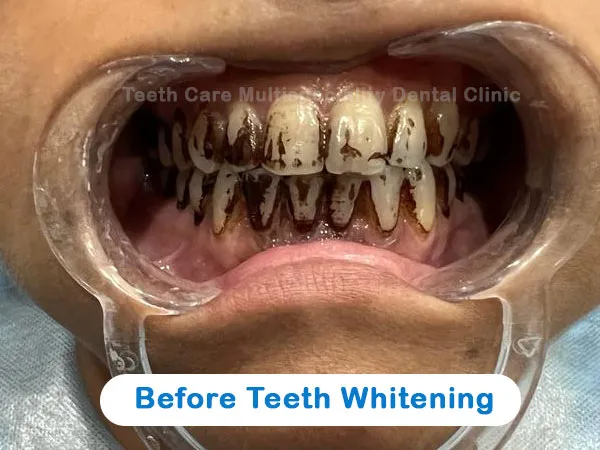 27801 teeth whitening kolkata image6