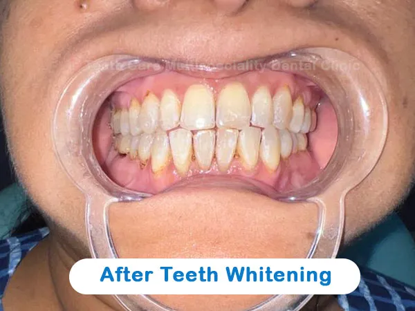 /img/27801-teeth-whitening-kolkata-image7.webp