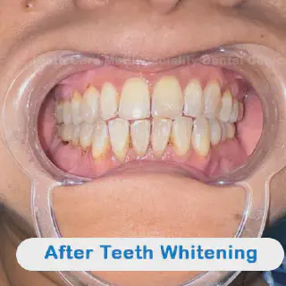 /img/27801-teeth-whitening-kolkata-image7.webp
