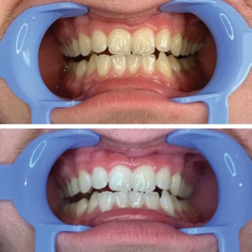 27814 ricci whitening cost