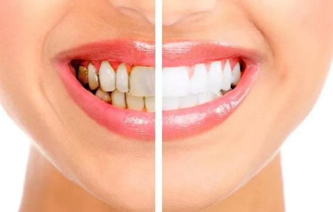 27817 teeth whitening class 3