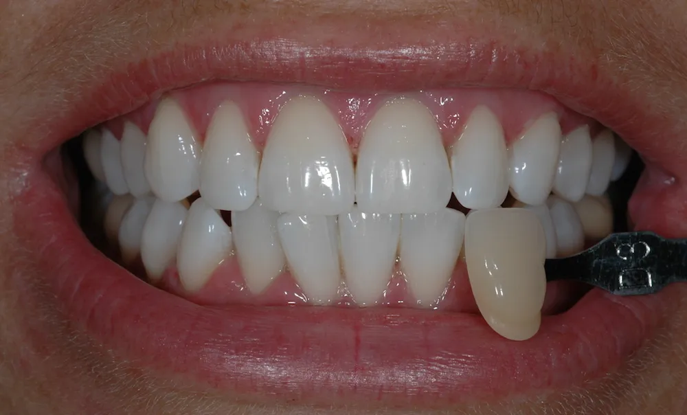 27831 dead tooth uk image3