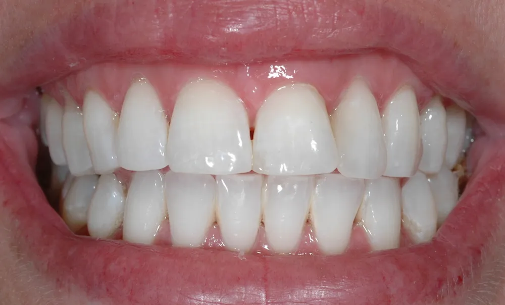 27831 dead tooth uk image4