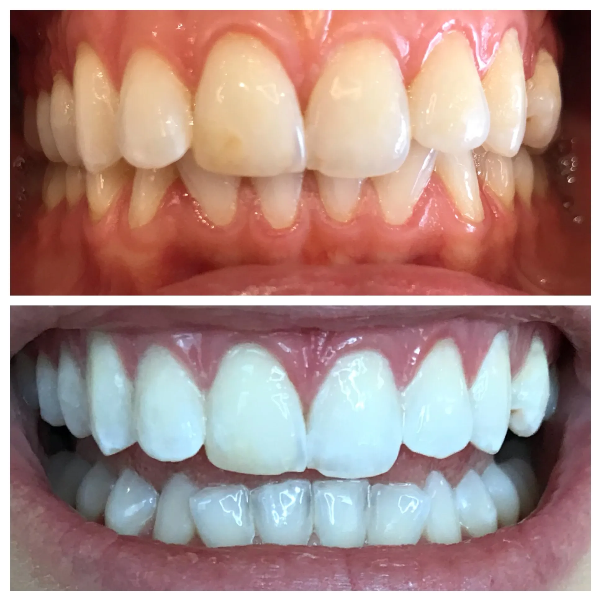 27835 professional teeth whitening