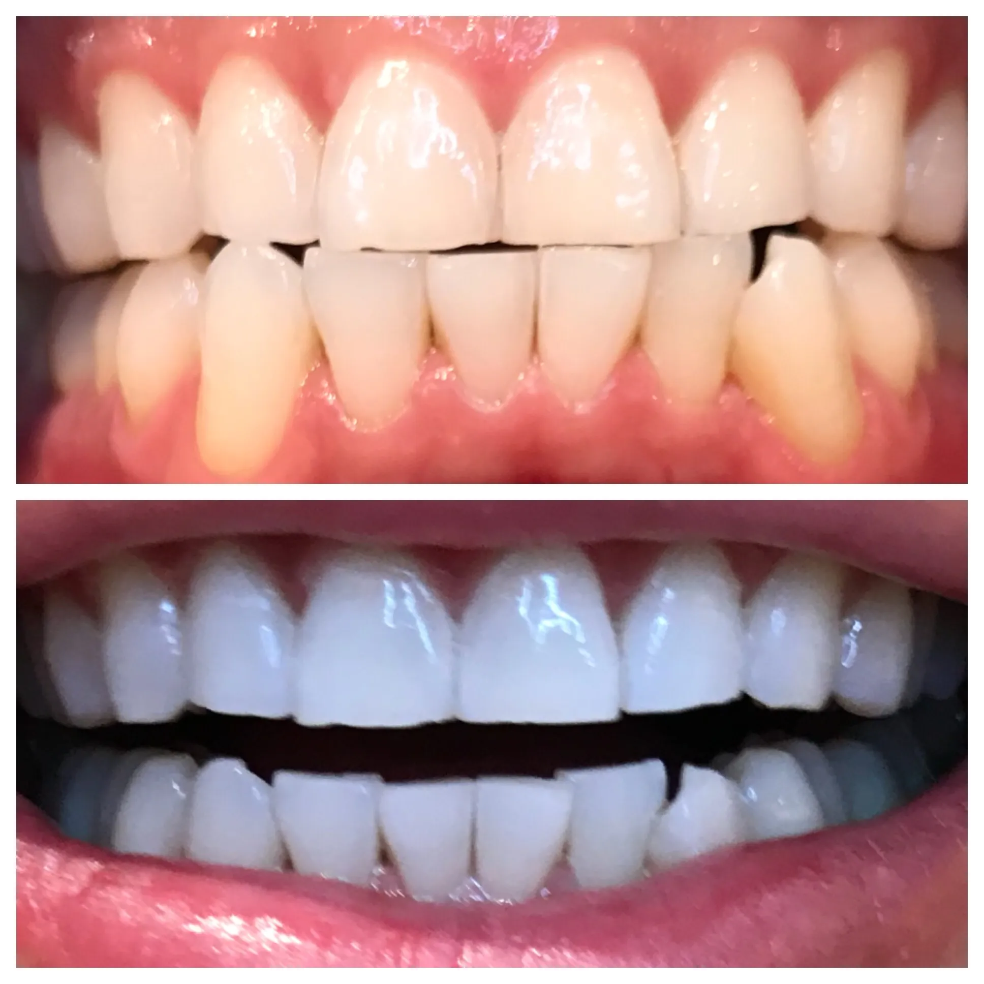 27835 teeth whitening before after