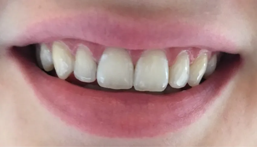 27843 teeth whitening 3d strips 2