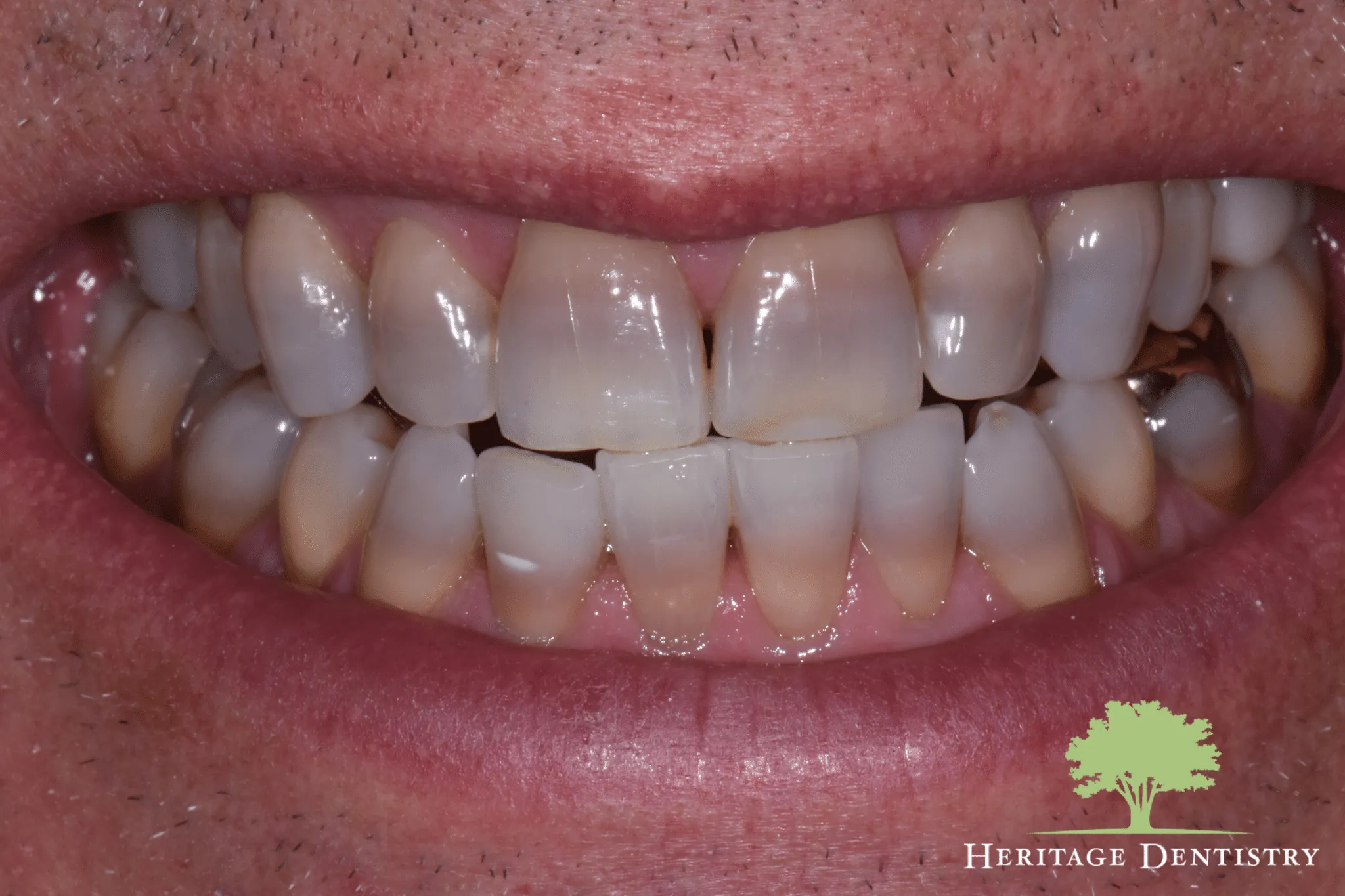 27851 teeth whitening greenville sc dental clinic