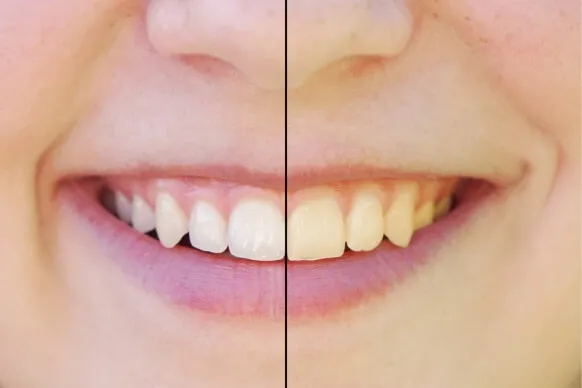 27859 yellow teeth after whitening 5