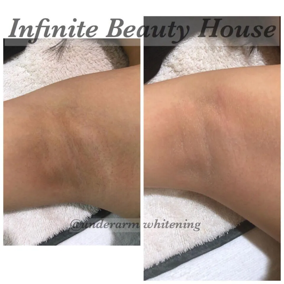 27860 laser therapy bello