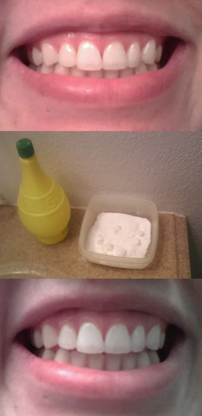 27864 led light teeth whitening