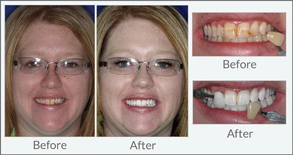 27867 teeth whitening results