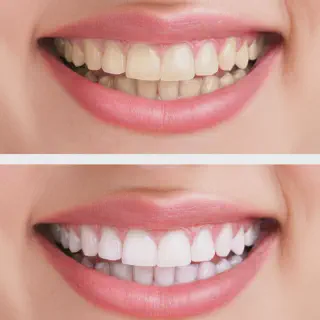 /img/27874-teeth-whitening-dentist-checkup.webp