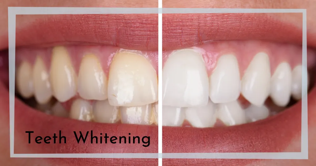 27893 teeth whitening mt pleasant sc before after