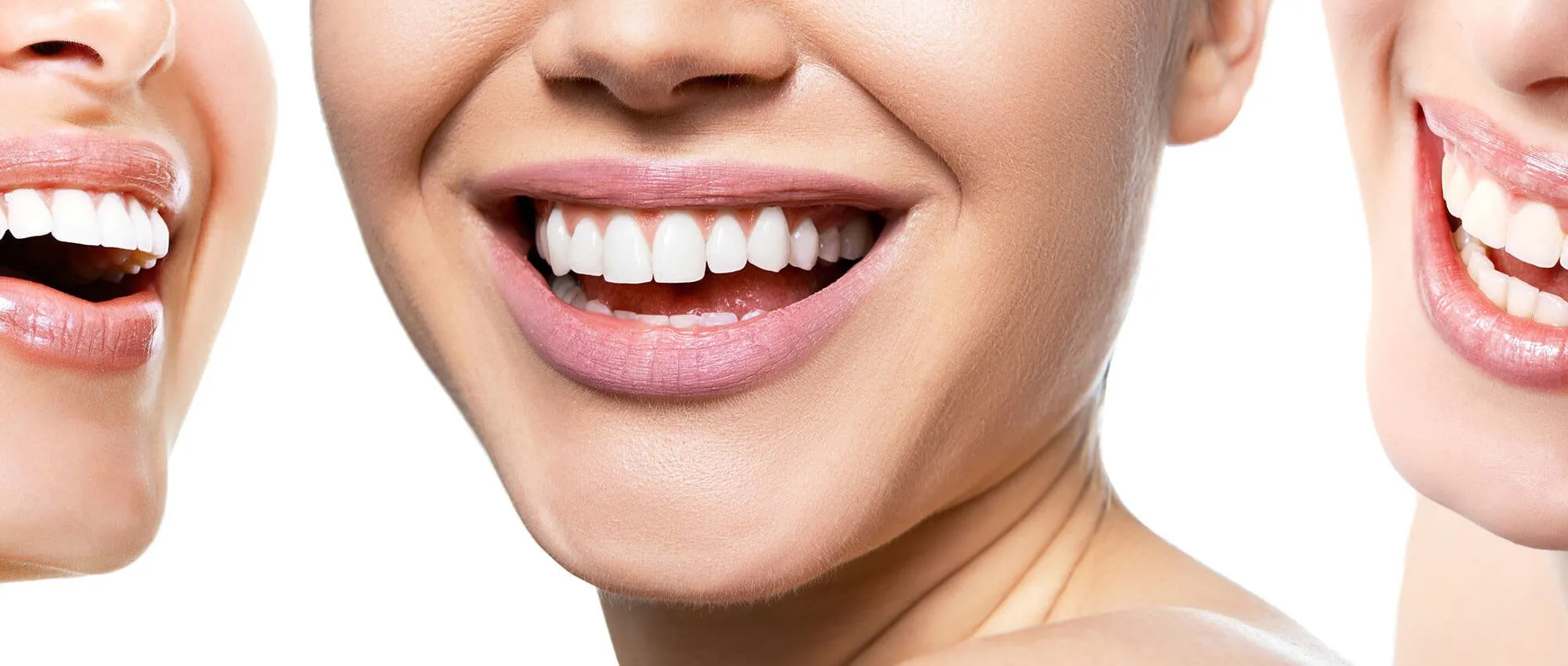 27893 teeth whitening mt pleasant sc professional