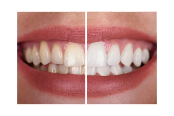 /img/27899-teeth-whitening-georgetown-tx-care.webp