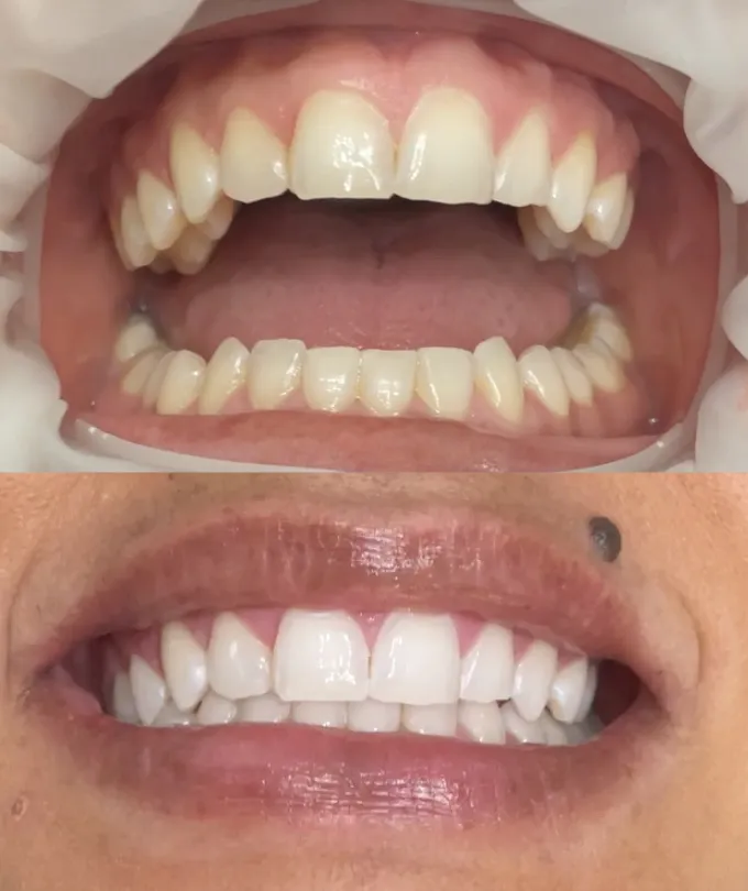 27905 customized teeth whitening