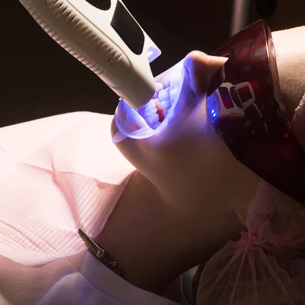 27905 zoom teeth whitening process