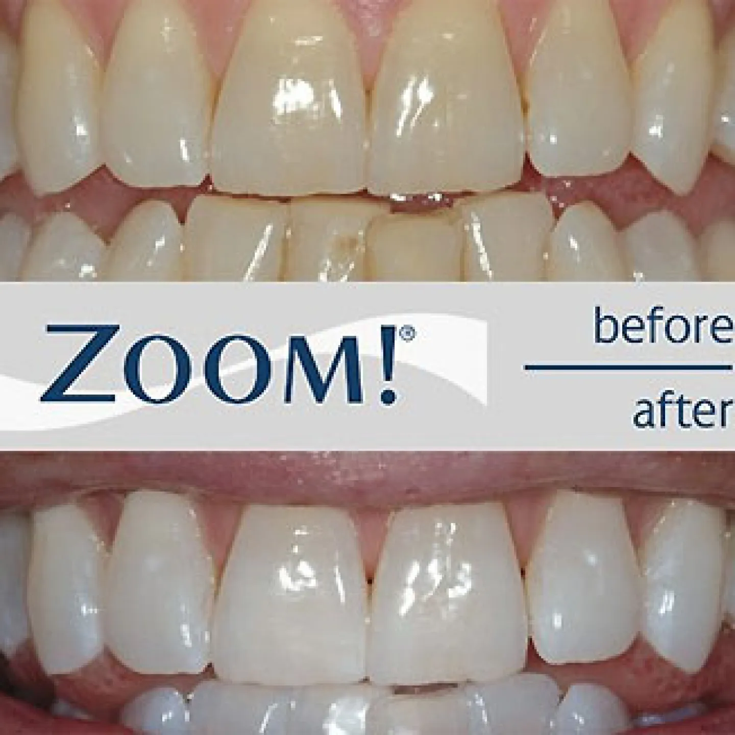 27905 zoom whitening results